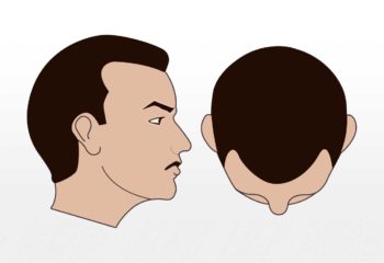 1500-2000 Grafts 1500-2000 Grafts