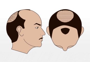 2800-3300 Grafts 2800-3300 Grafts