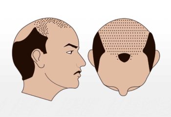 3000-3500 Grafts 3000-3500 Grafts