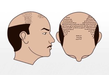 4000-7000 Grafts 4000-7000 Grafts