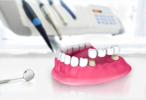 Dental Bridge