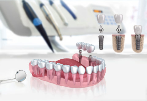 Dental implants Turkey