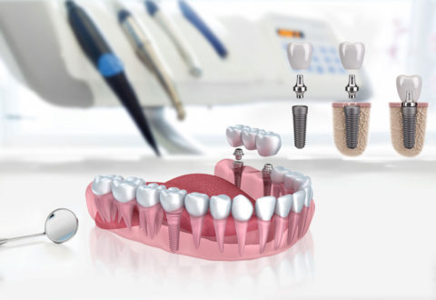 Dental Implants Turkey