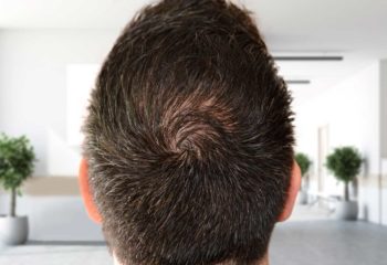 Hair transplant crown Technique