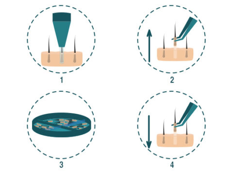 Hair transplant FUE Method