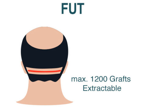 Hair Transplant Fut Technique