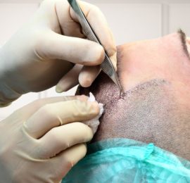 Hair transplant Manuel