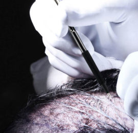 Hair Transplant Perkutan FUE Technique