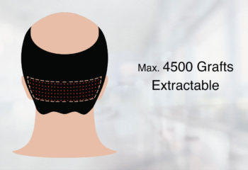 Hair Transplant Fue Technique