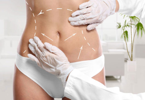 Liposuction in Istanbul