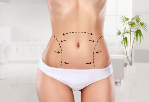 Liposuction in Turkey