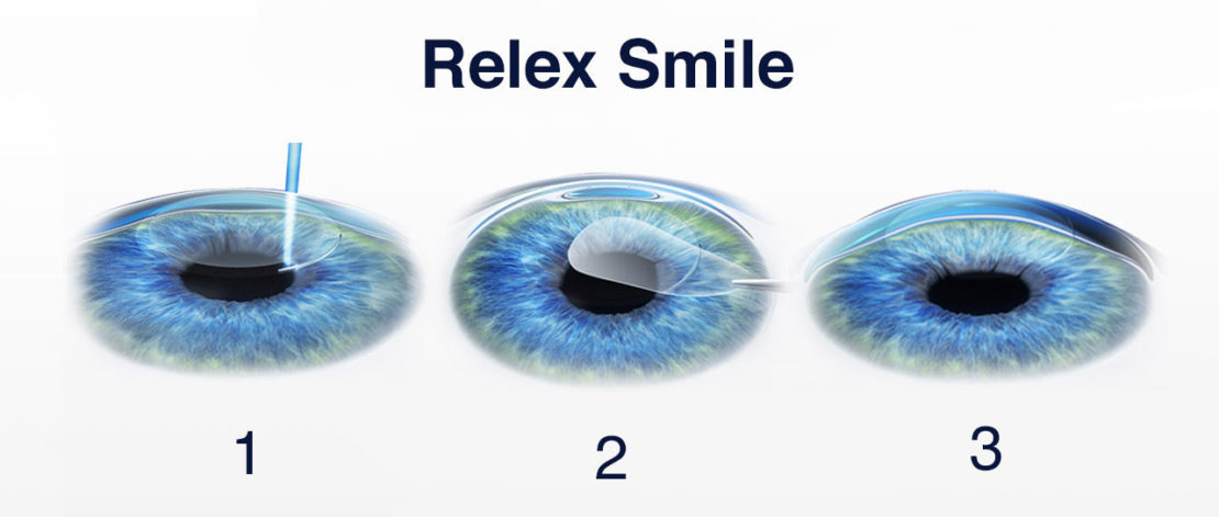 Relex Smile Turkey