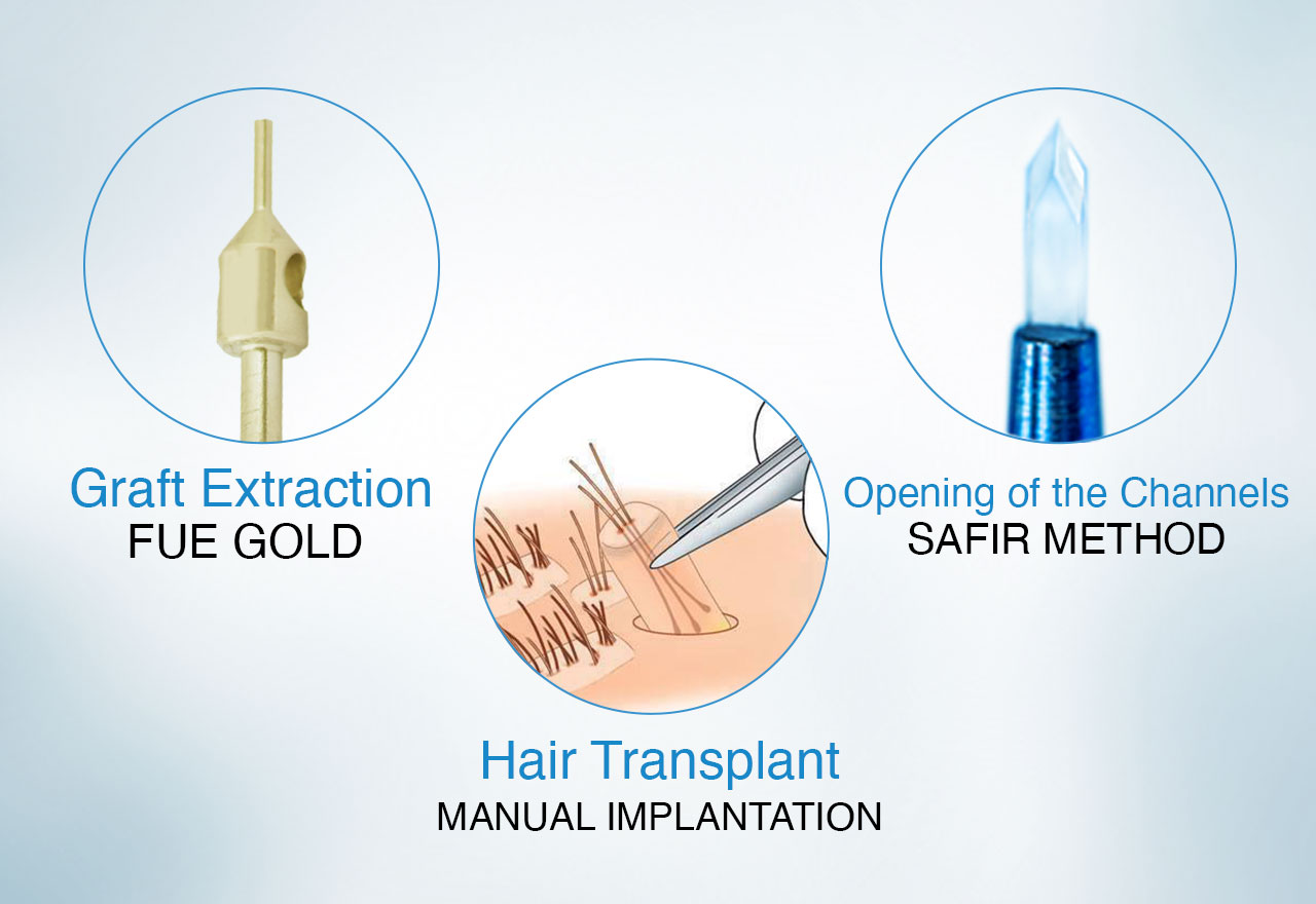 Hair transplant fue gold method