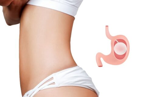 Gastric Balloon