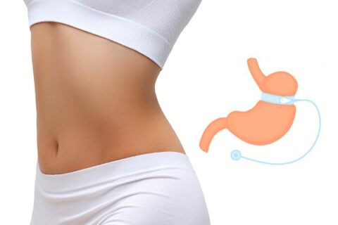Gastric Band