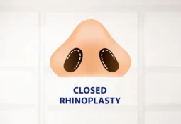 Closed Rhinoplasty Closed Rhinoplasty