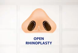 Open Rhinoplasty Open Rhinoplasty