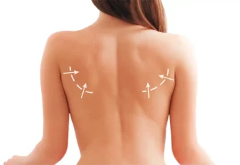 Back Liposuction Back Liposuction