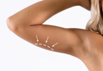 Liposuction Arms Liposuction Arms