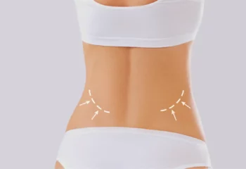 Liposuction Hips Liposuction Hips