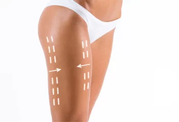 Saddlebag Liposuction Saddlebag Liposuction