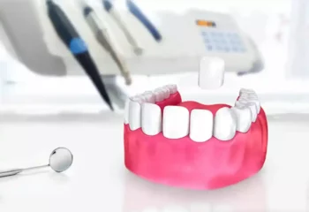Non prep Veneers