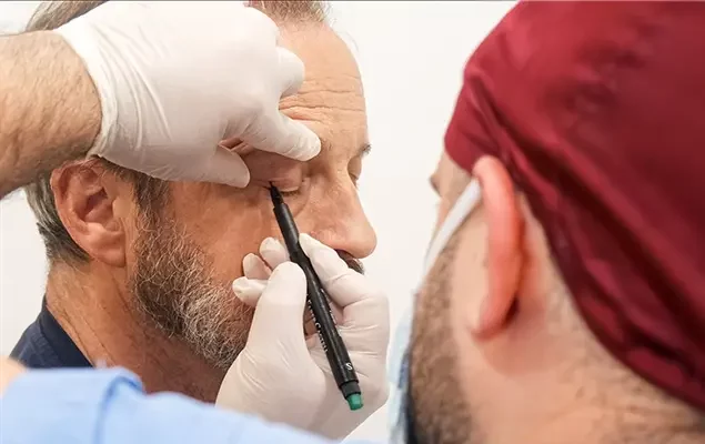 hair-transplantation-and-eyelid